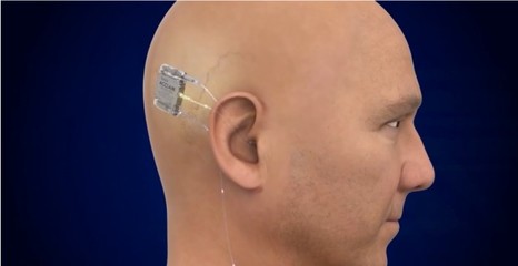 新医学|全球唯一完全植入式人工耳蜗通过FDA(2022北京国际生命健康博览会特别报道)