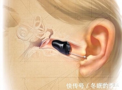 潼南惠耳分享--人工耳蜗和助听器的区别是什么?