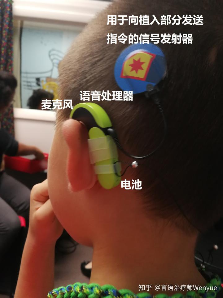 电子耳蜗:先天性耳聋患儿的福音