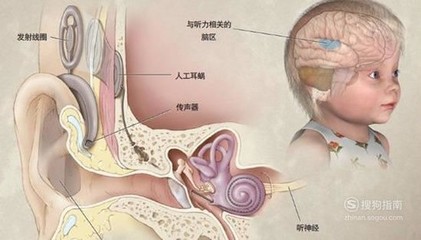 助听器和人工耳蜗的区别