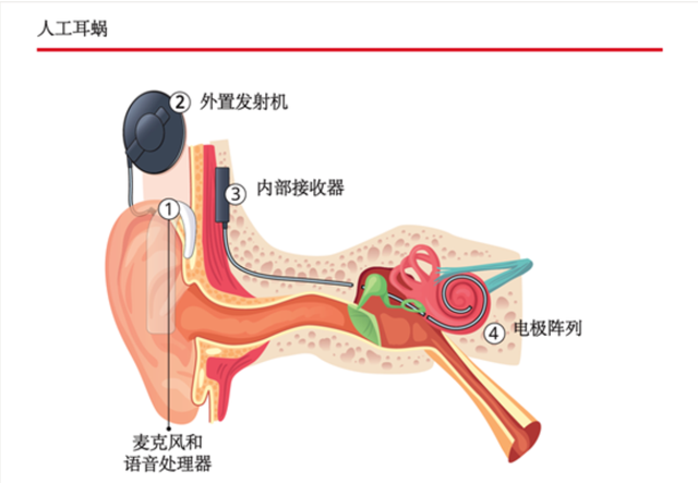 人工耳蜗.图片来源:世界卫生组织《世界听力报告》