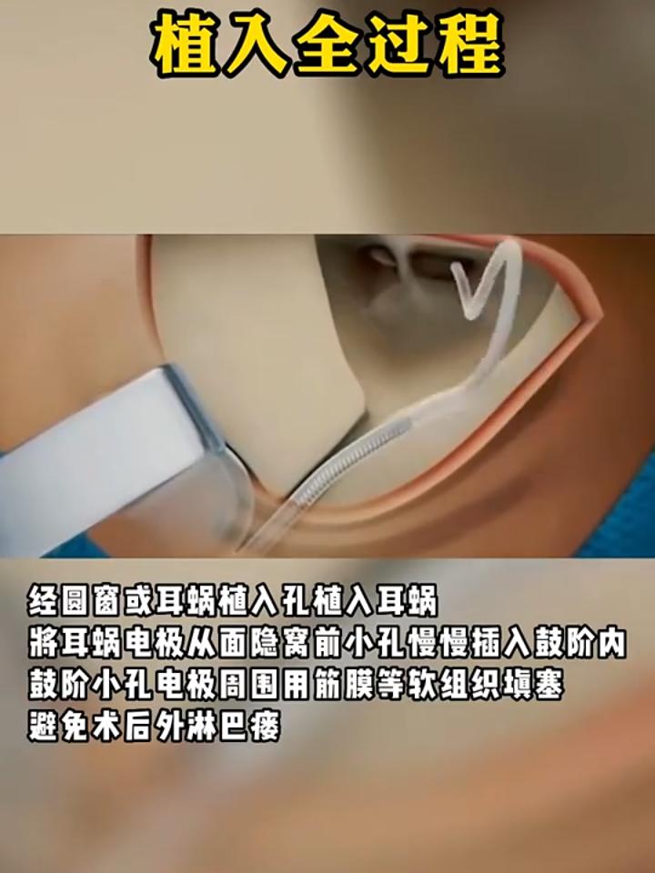 电子人工耳蜗植入全过程